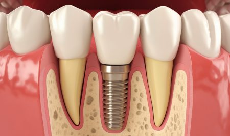 Cross section of the jaw with an embedded dental implant in the gum --ar 5:3 --style raw --v 6 Job ID: 7fab9317-9607-497d-a737-a3ea93db9717